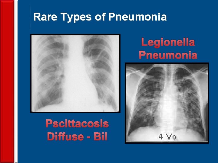 Rare Types of Pneumonia Legionella Pneumonia Pscittacosis Diffuse - Bil 74 