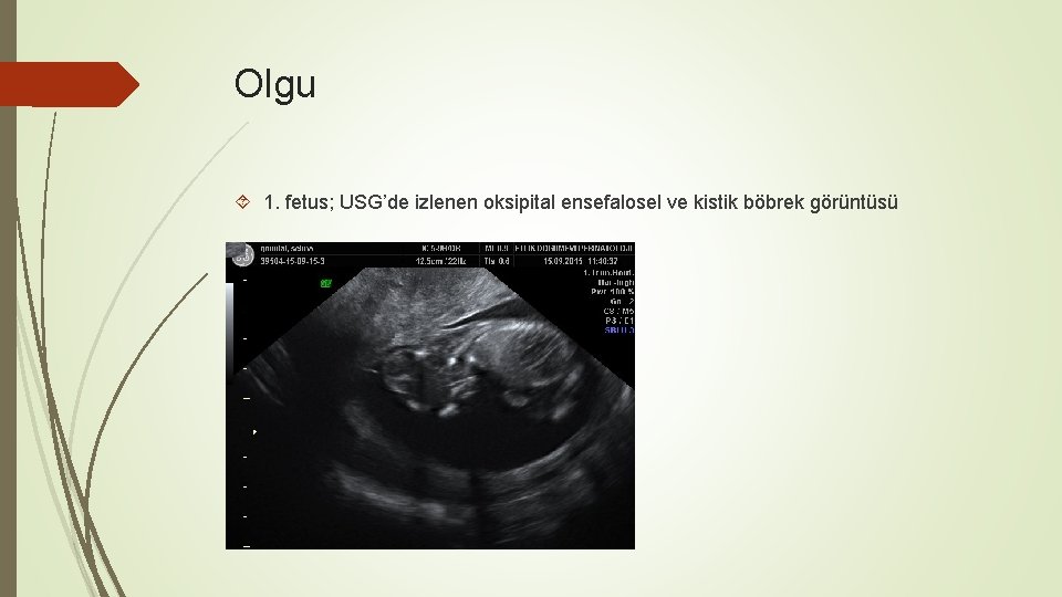 Olgu 1. fetus; USG’de izlenen oksipital ensefalosel ve kistik böbrek görüntüsü 