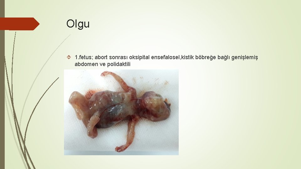 Olgu 1. fetus; abort sonrası oksipital ensefalosel, kistik böbreğe bağlı genişlemiş abdomen ve polidaktili