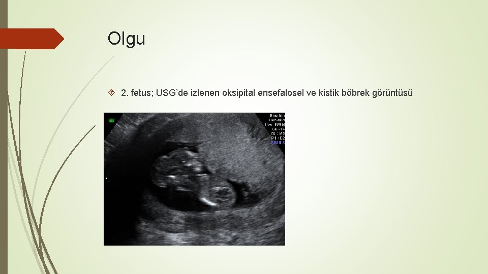 Olgu 2. fetus; USG’de izlenen oksipital ensefalosel ve kistik böbrek görüntüsü 