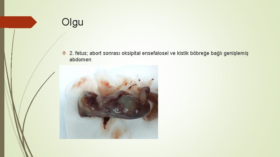 Olgu 2. fetus; abort sonrası oksipital ensefalosel ve kistik böbreğe bağlı genişlemiş abdomen 