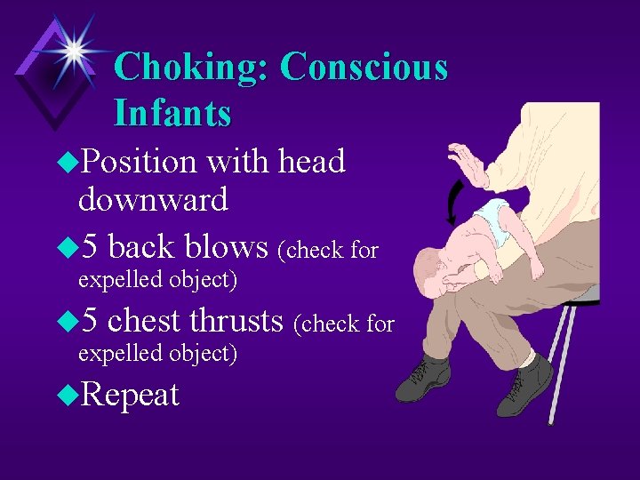 Choking: Conscious Infants u. Position with head downward u 5 back blows (check for