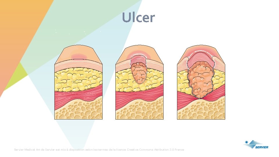Ulcer Servier Medical Art de Servier est mis à disposition selon les termes de