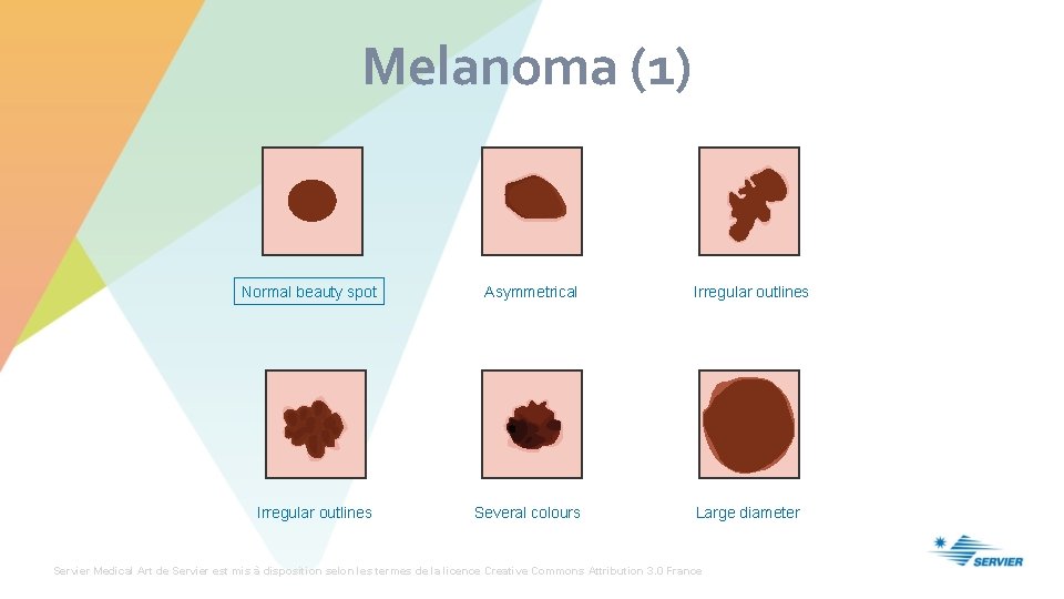 Melanoma (1) Normal beauty spot Asymmetrical Irregular outlines Several colours Large diameter Servier Medical