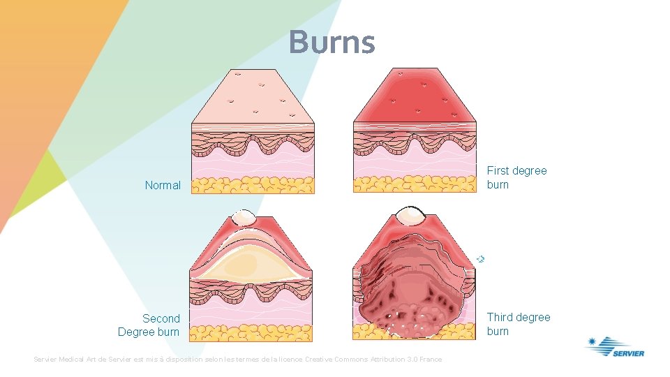 Burns Normal Second Degree burn Servier Medical Art de Servier est mis à disposition