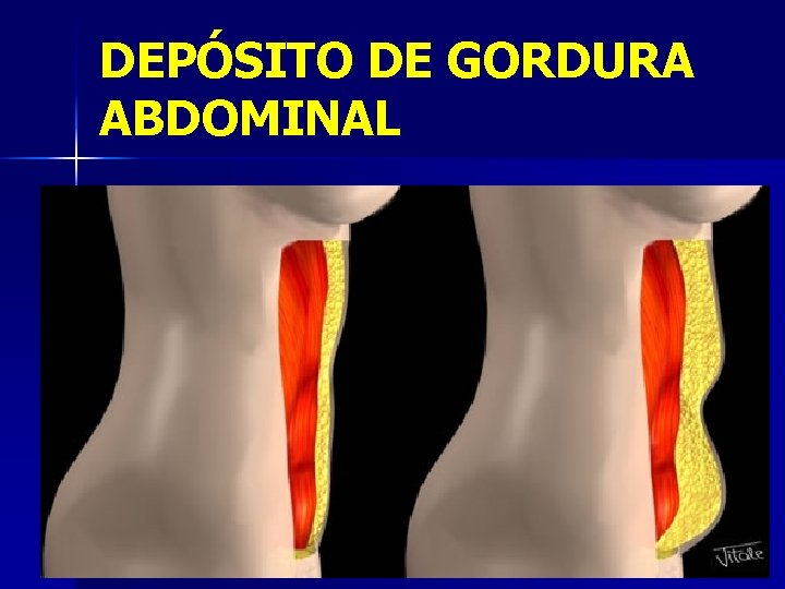 DEPÓSITO DE GORDURA ABDOMINAL 