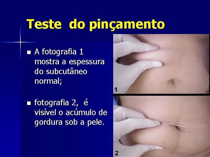 Teste do pinçamento n A fotografia 1 mostra a espessura do subcutâneo normal; n