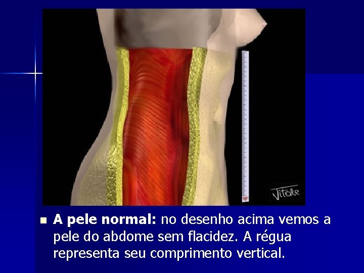 n A pele normal: no desenho acima vemos a pele do abdome sem flacidez.