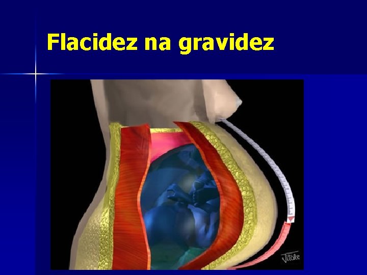 Flacidez na gravidez 