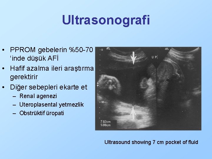 Ultrasonografi • PPROM gebelerin %50 -70 ‘inde düşük AFİ • Hafif azalma ileri araştırma