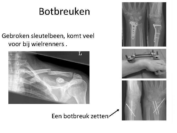 Botbreuken Gebroken sleutelbeen, komt veel voor bij wielrenners. Een botbreuk zetten 