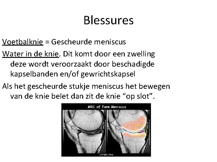 Blessures Voetbalknie = Gescheurde meniscus Water in de knie. Dit komt door een zwelling