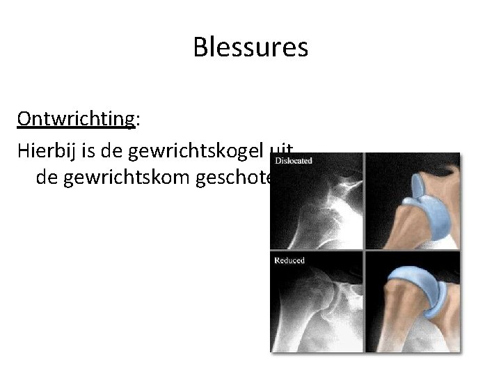 Blessures Ontwrichting: Hierbij is de gewrichtskogel uit de gewrichtskom geschoten 