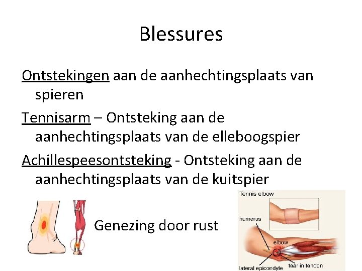 Blessures Ontstekingen aan de aanhechtingsplaats van spieren Tennisarm – Ontsteking aan de aanhechtingsplaats van