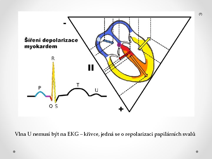 (7) Vlna U nemusí být na EKG – křivce, jedná se o repolarizaci papilárních