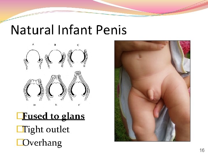 Natural Infant Penis �Fused to glans �Tight outlet �Overhang 16 
