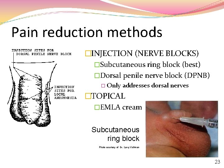 Pain reduction methods �INJECTION (NERVE BLOCKS) �Subcutaneous ring block (best) �Dorsal penile nerve block