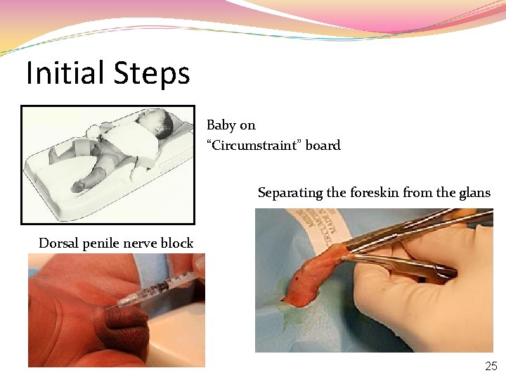 Initial Steps Baby on “Circumstraint” board Separating the foreskin from the glans Dorsal penile