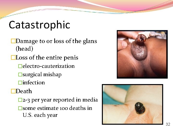 Catastrophic �Damage to or loss of the glans (head) �Loss of the entire penis