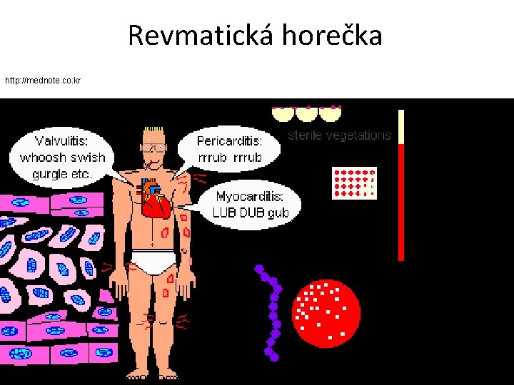 Revmatická horečka http: //mednote. co. kr 