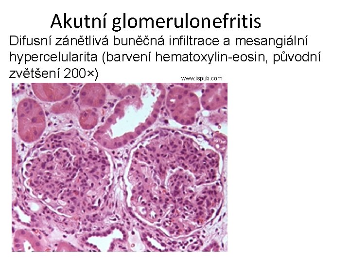 Akutní glomerulonefritis Difusní zánětlivá buněčná infiltrace a mesangiální hypercelularita (barvení hematoxylin-eosin, původní zvětšení 200×)