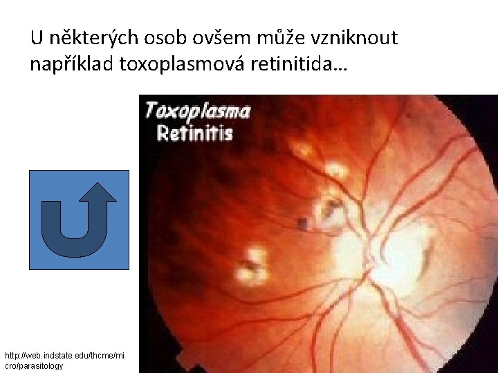 U některých osob ovšem může vzniknout například toxoplasmová retinitida… http: //web. indstate. edu/thcme/mi cro/parasitology