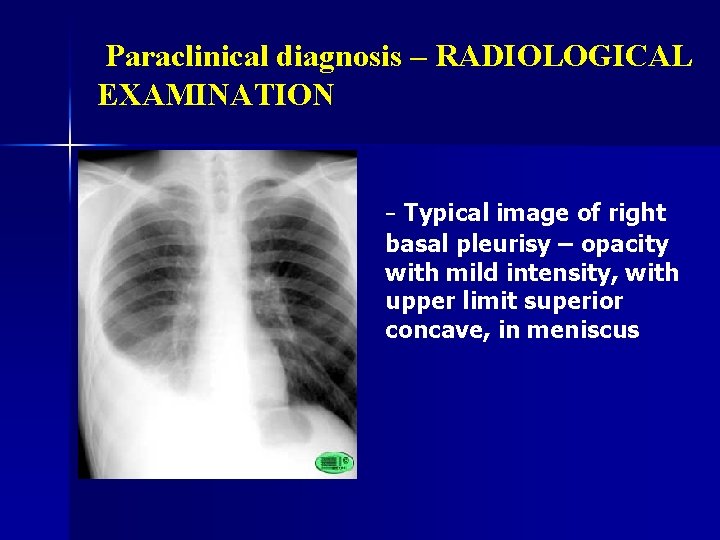 Paraclinical diagnosis – RADIOLOGICAL EXAMINATION - Typical image of right basal pleurisy – opacity