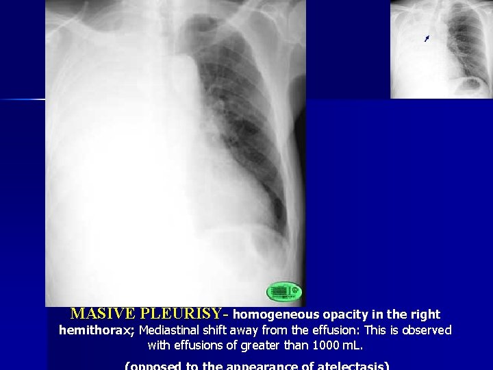 MASIVE PLEURISY- homogeneous opacity in the right hemithorax; Mediastinal shift away from the effusion: