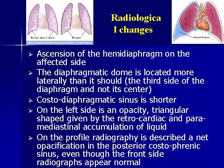 Radiologica l changes Ø Ø Ø Ascension of the hemidiaphragm on the affected side