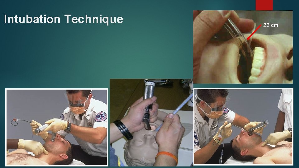 Intubation Technique 22 cm 