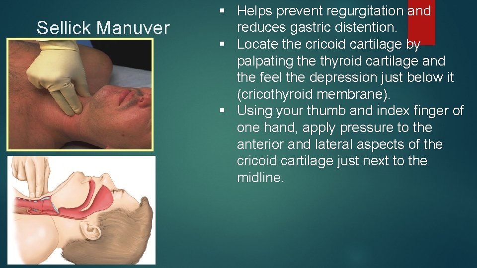 Sellick Manuver § Helps prevent regurgitation and reduces gastric distention. § Locate the cricoid