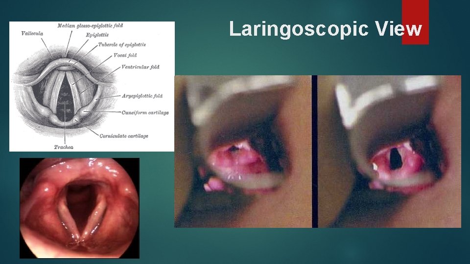 Laringoscopic View 