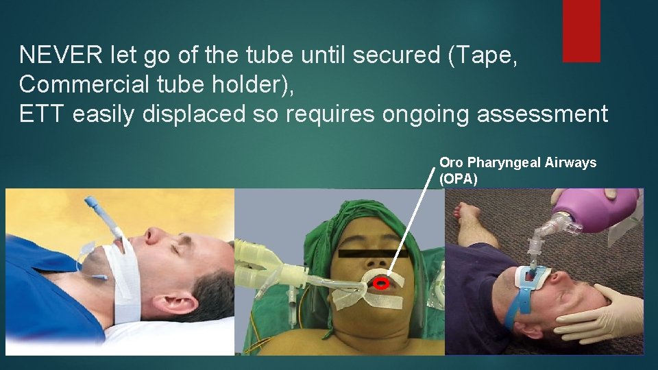 NEVER let go of the tube until secured (Tape, Commercial tube holder), ETT easily