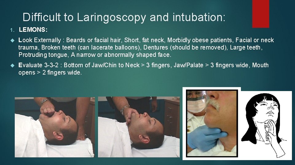 Difficult to Laringoscopy and intubation: 1. LEMONS: Look Externally : Beards or facial hair,
