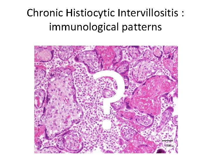 Chronic Histiocytic Intervillositis : immunological patterns ? 