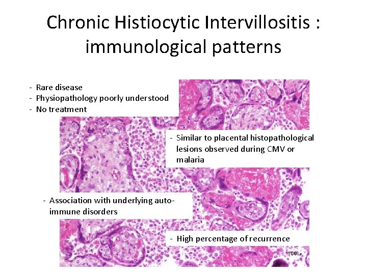 Chronic Histiocytic Intervillositis : immunological patterns - Rare disease - Physiopathology poorly understood -