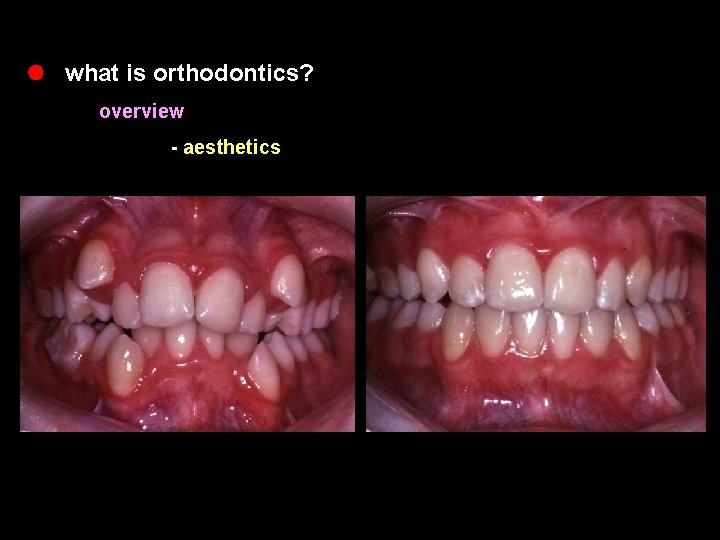 l what is orthodontics? overview - aesthetics 