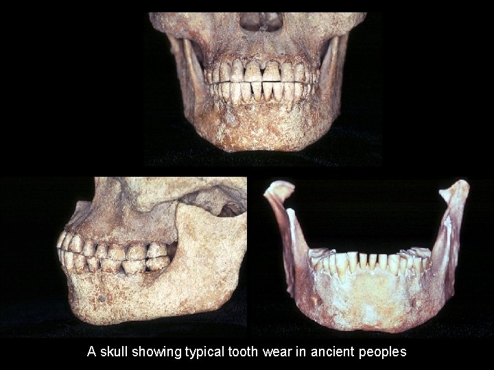 A skull showing typical tooth wear in ancient peoples 