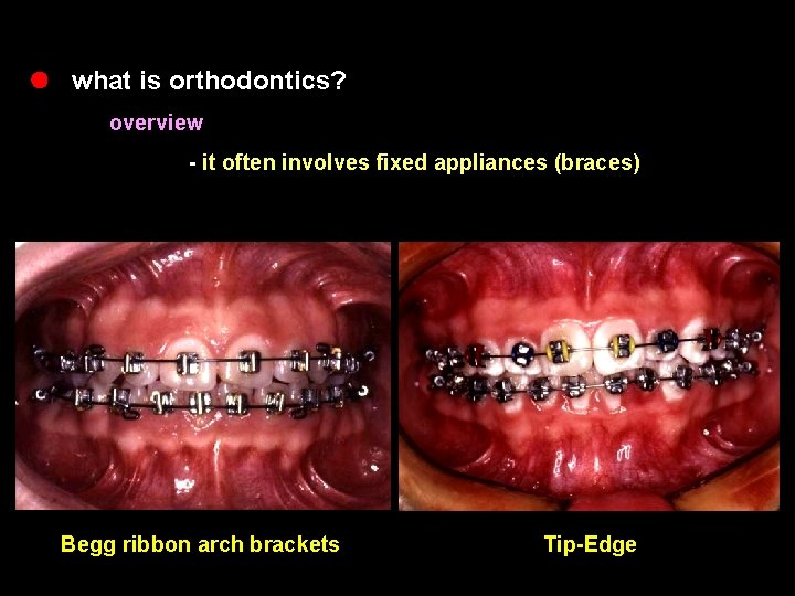 l what is orthodontics? overview - it often involves fixed appliances (braces) Begg ribbon