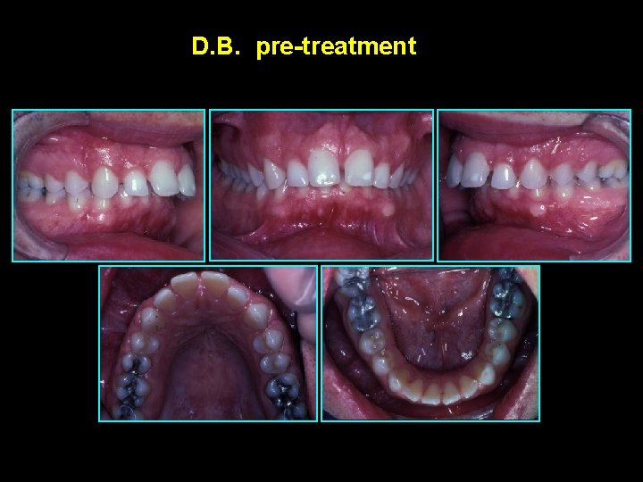 D. B. pre-treatment 