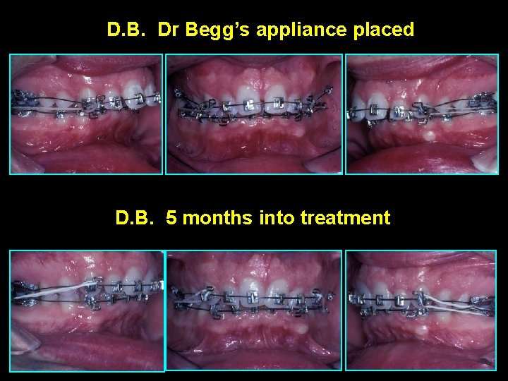 D. B. Dr Begg’s appliance placed D. B. 5 months into treatment 