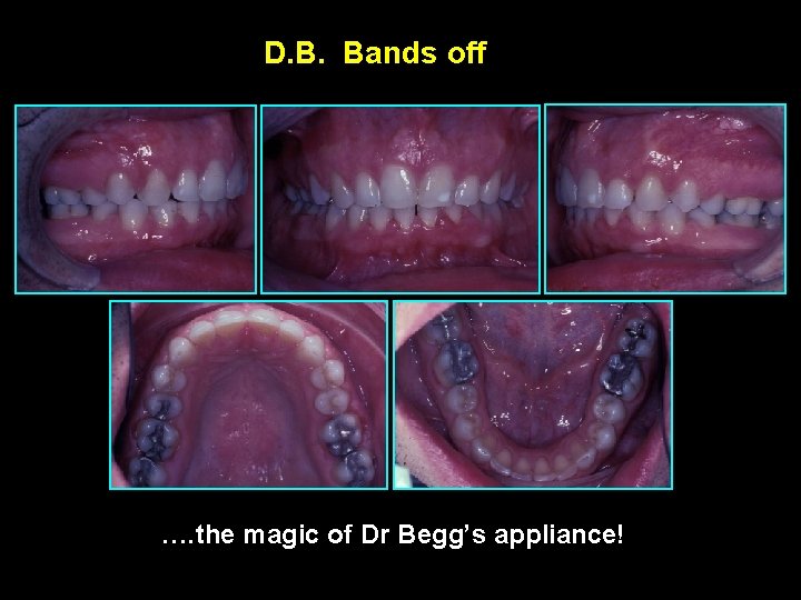 D. B. Bands off …. the magic of Dr Begg’s appliance! 