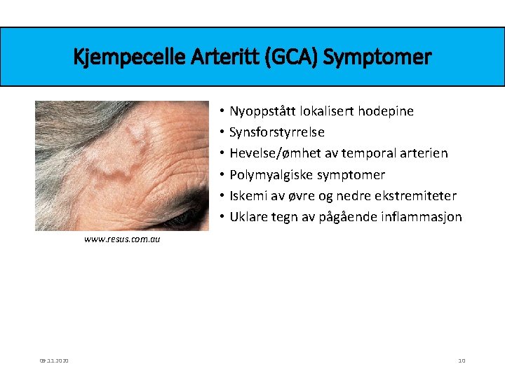 Kjempecelle Arteritt (GCA) Symptomer • Nyoppstått lokalisert hodepine • Synsforstyrrelse • Hevelse/ømhet av temporal