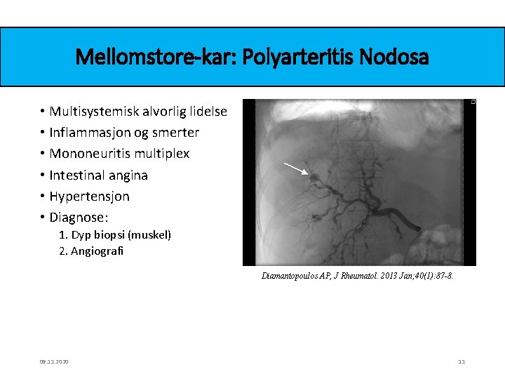 Mellomstore-kar: Polyarteritis Nodosa • Multisystemisk alvorlig lidelse • Inflammasjon og smerter • Mononeuritis multiplex