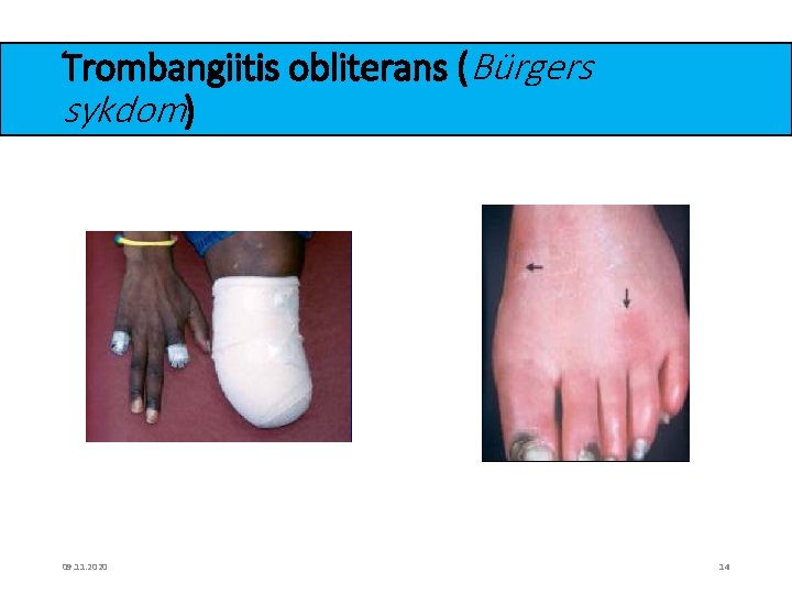 Trombangiitis obliterans (Bürgers sykdom) 09. 11. 2020 14 