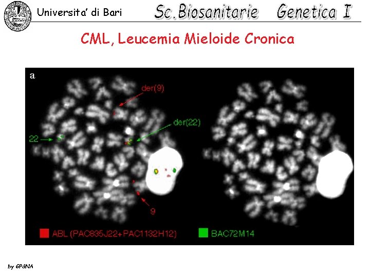 Universita’ di Bari CML, Leucemia Mieloide Cronica by GP&NA 