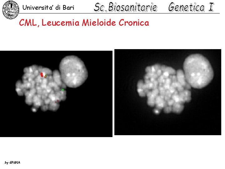 Universita’ di Bari CML, Leucemia Mieloide Cronica by GP&NA 