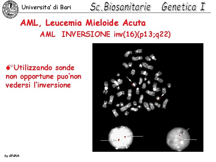 Universita’ di Bari AML, Leucemia Mieloide Acuta AML INVERSIONE inv(16)(p 13; q 22) MUtilizzando