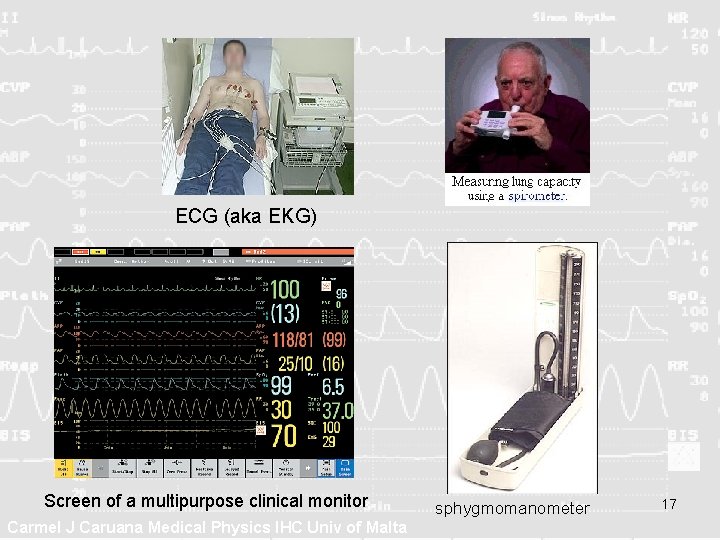 ECG (aka EKG) Screen of a multipurpose clinical monitor Carmel J Caruana Medical Physics ECG (aka EKG) Screen of a multipurpose clinical monitor Carmel J Caruana Medical Physics