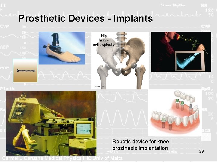 Prosthetic Devices - Implants Robotic device for knee prosthesis implantation Carmel J Caruana Medical Prosthetic Devices - Implants Robotic device for knee prosthesis implantation Carmel J Caruana Medical